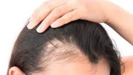 জেনে নিন চুল পড়ার কারণগুলো