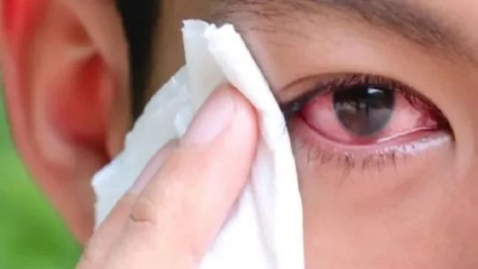 কঠিন যেসব রোগের লক্ষণ ফুটে ওঠে চোখে