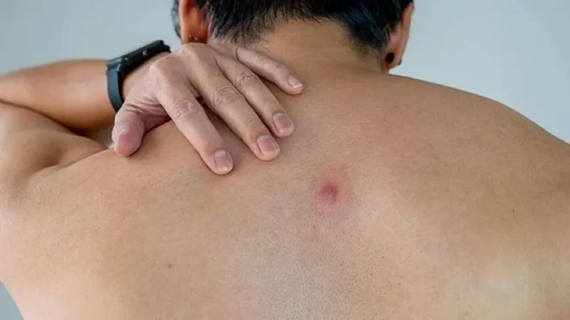 বারবার ফোড়া হওয়া কিসের লক্ষণ? হলে কী করনীয়?